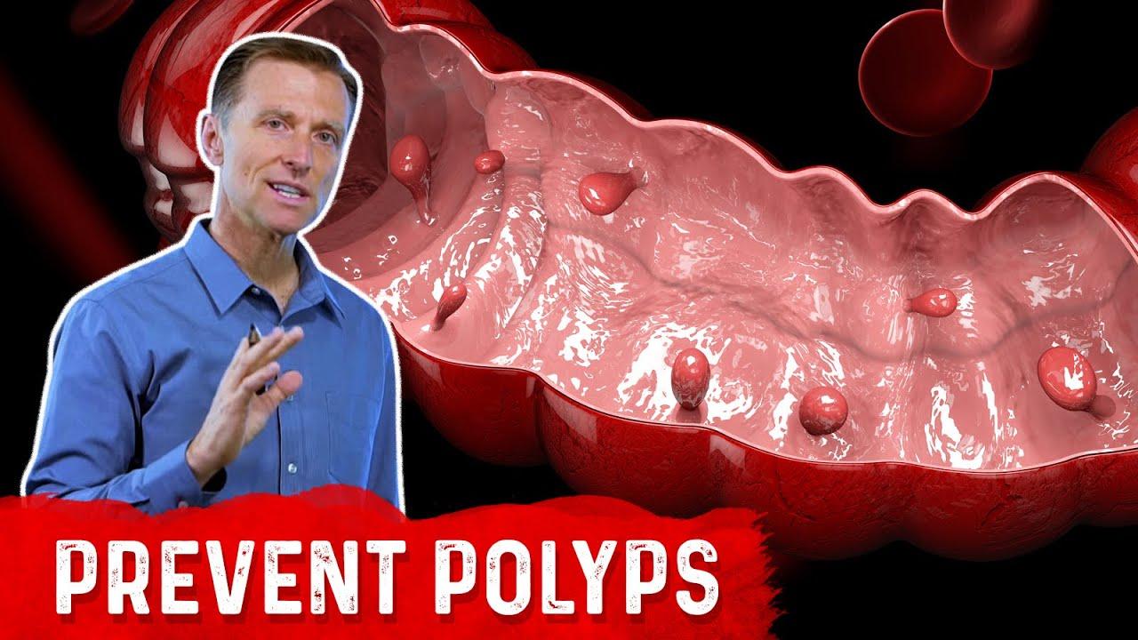 What Is A Polyp The Best Food For Colon Polyp Prevention Dr Berg